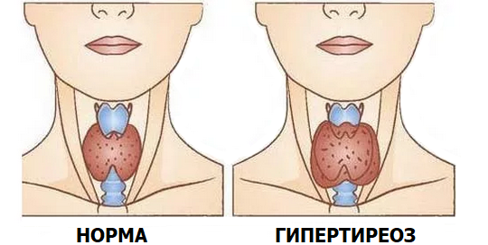 Симптомы гипертиреоза Симптомы гипертиреоза