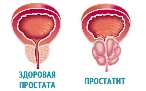 Симптомы простатита Симптомы простатита